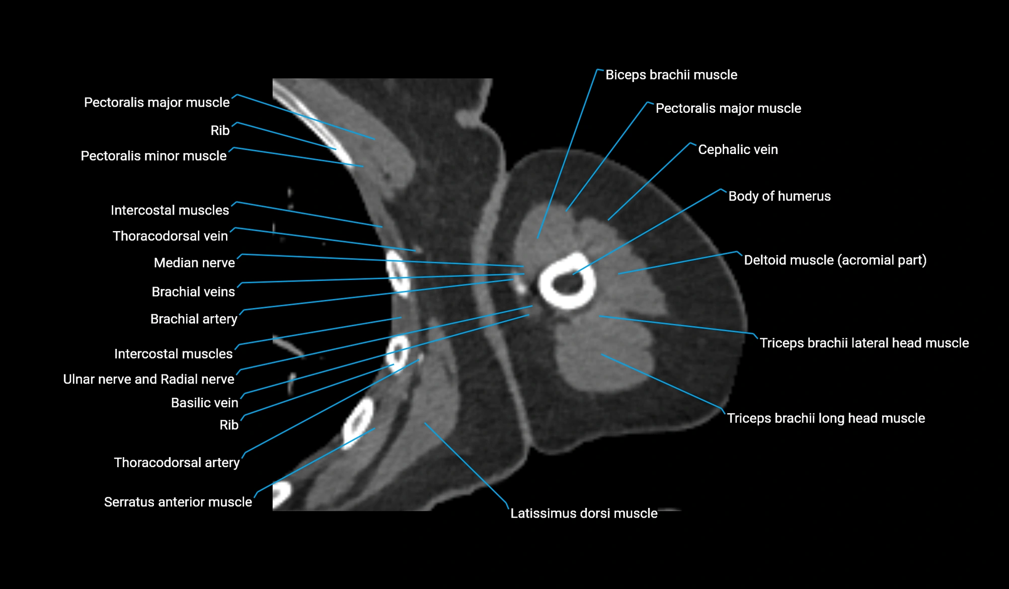 CT upper arm axial  cross sectional anatomy labelled radiology image -00182.webp